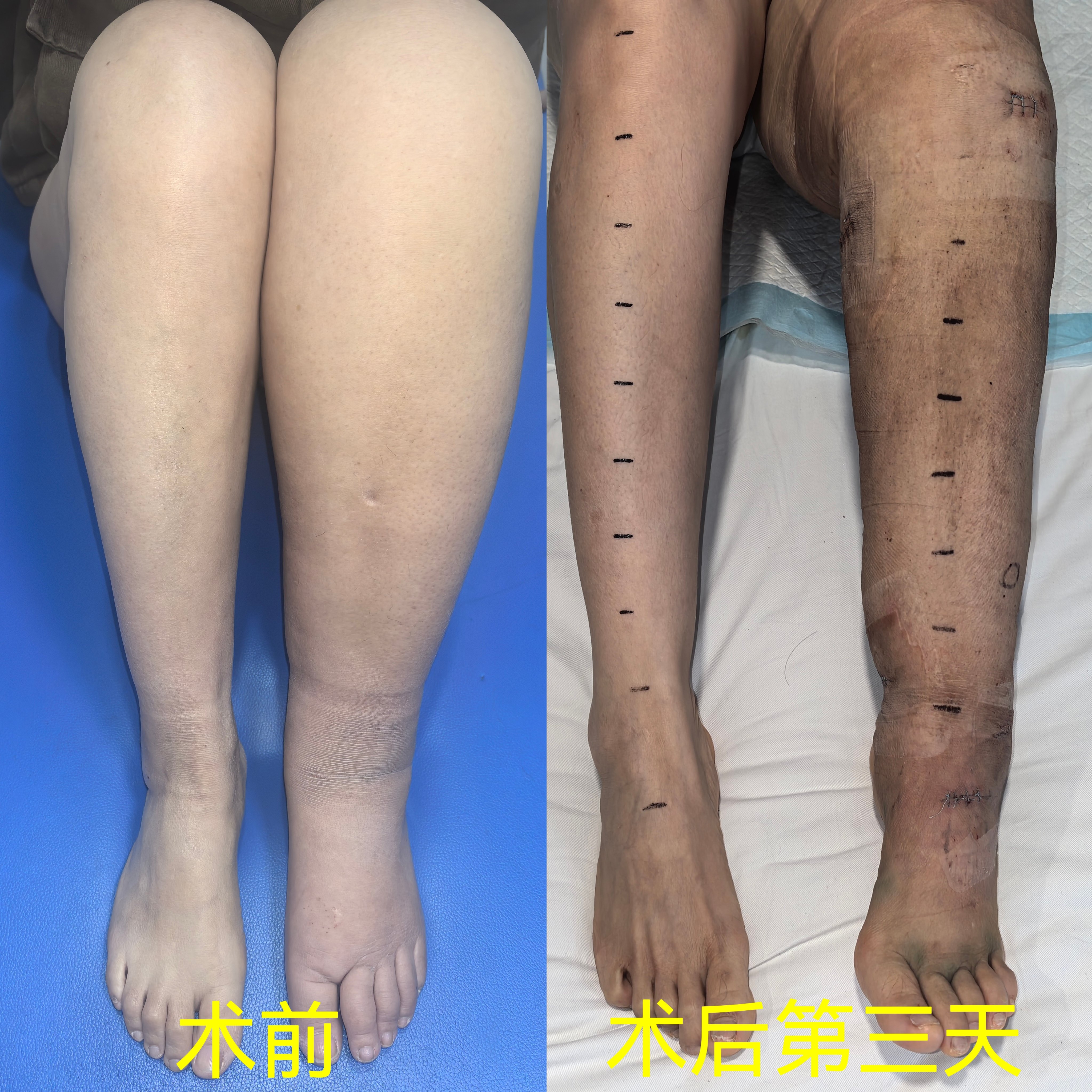 First cancer, then edema! The 41 year old woman who successf