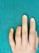 Why do we need finger reconstruction? Among countless answer