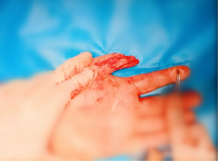 After hearing another patient's story, the 24-year-old
