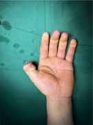 A 34-year-old man recounts: Micro-aesthetic reconstruction t