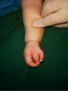 Five Years After Polydactyly Surgery: Superlatives Keep Appe